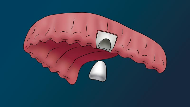 A full arch with no teeth. There is a hole in the gums. A piece of bone for a bone-graft is just below the hole.