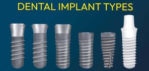 Different types of dental implants that doctors use in Mexico for All on 4 treatments.
