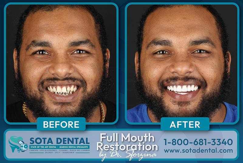 Before and After image of a dental implant patient in Mexico.